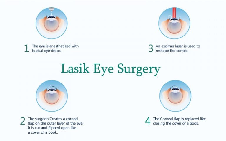 LASIK Eye Surgery Near Boynton Beach & Lake Worth, FL