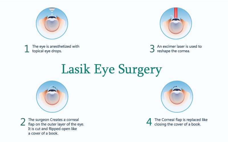 sour life Medieval LASIK Eye Surgery Near Boynton Beach & Lake Worth, FL
